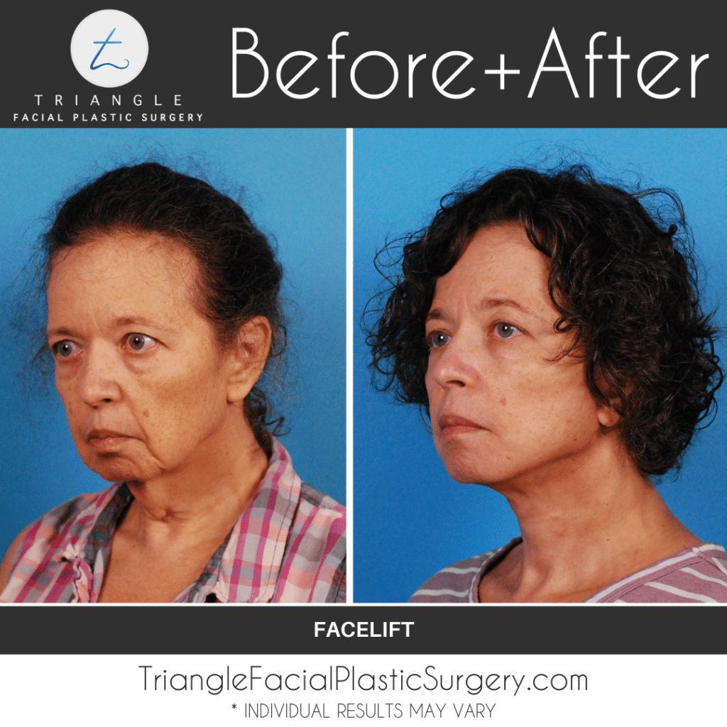 Facelift Before and After