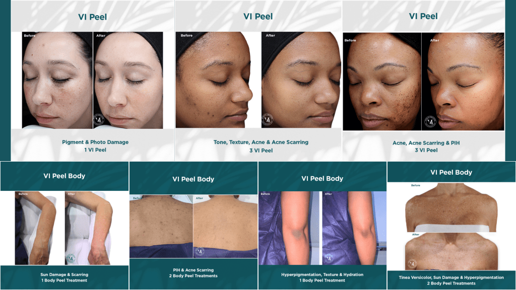 VI Peel Before and After