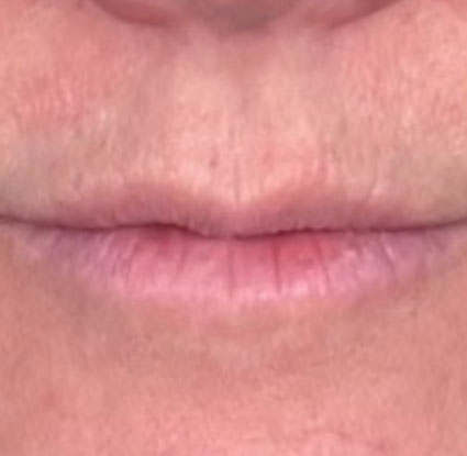 Before image