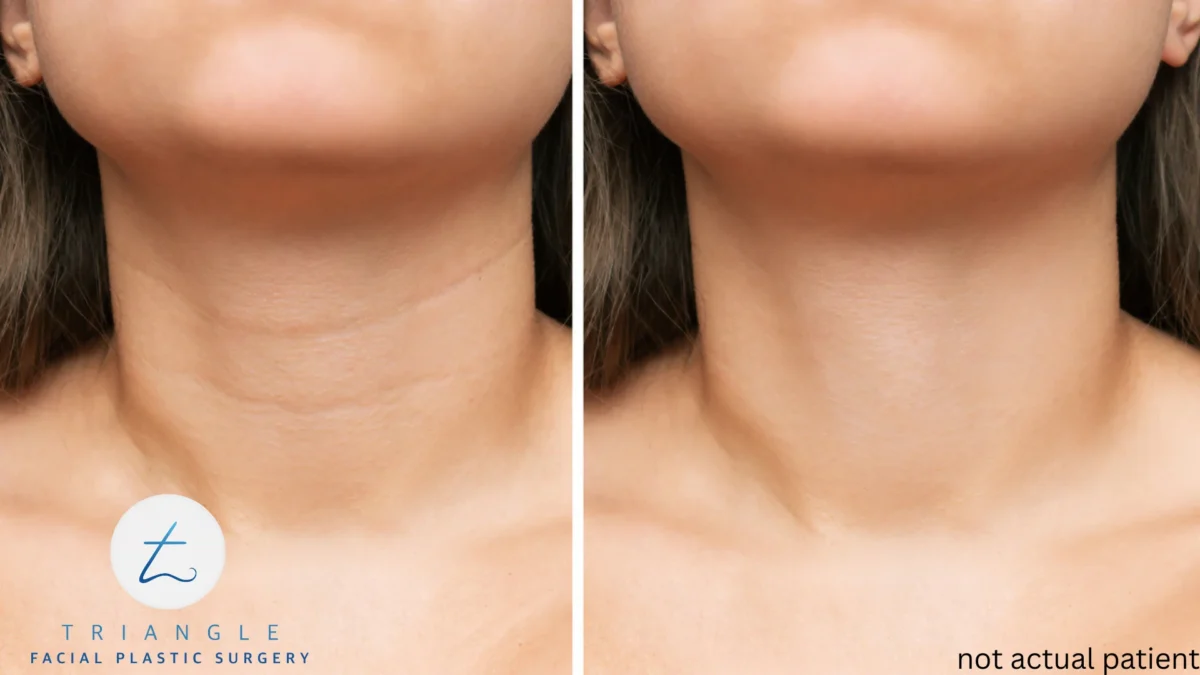 Before and after non-surgical neck rejuvenation treatment: Left side shows crepey texture, horizontal neck lines, and loss of firmness; right side displays smoother, firmer skin with reduced lines and improved elasticity.