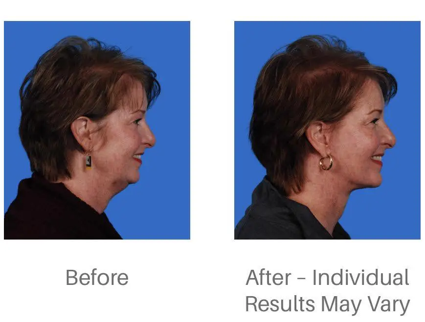 Why the Neck Often Reveals Your Age Before Your Face