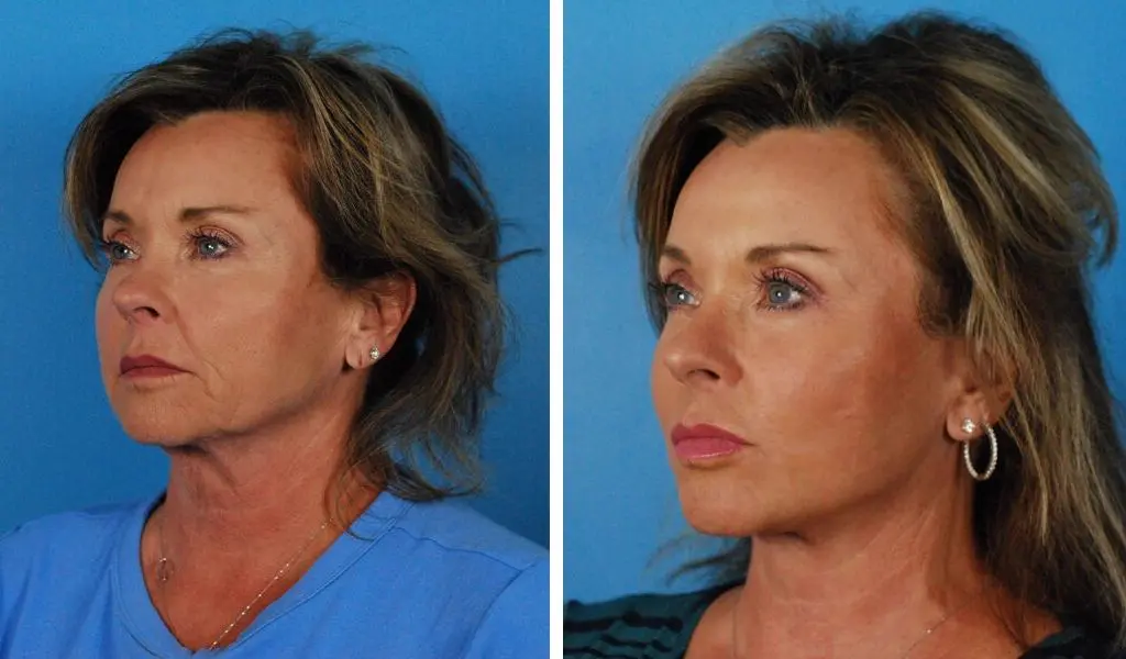 Facelift Before and After: Exploring Real Patient Results